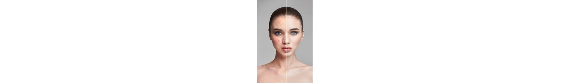 Acné & Imperfections | Soins Ciblés Visage