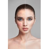 Acne et Imperfections