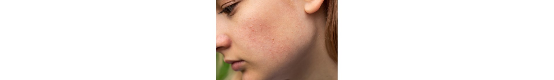 Soins Anti-Rougeurs | Peaux Réactives