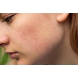 Soins Anti-rougeurs