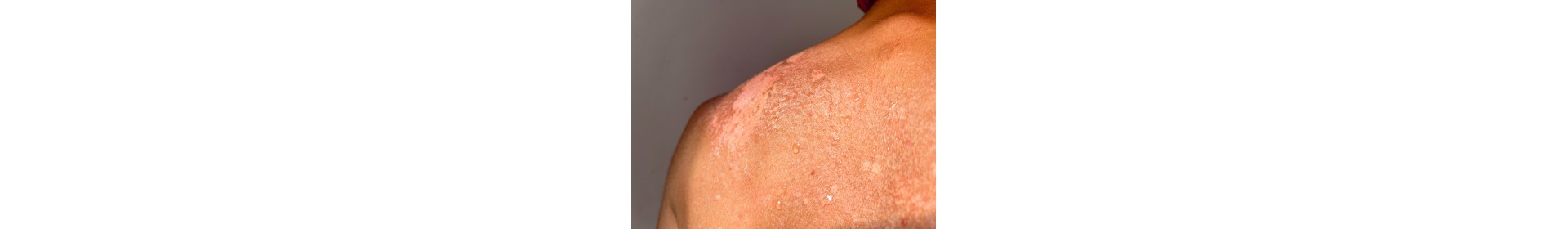 Crèmes Peaux Atopiques | Anti-Eczéma