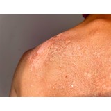 Cremes Anti-eczema