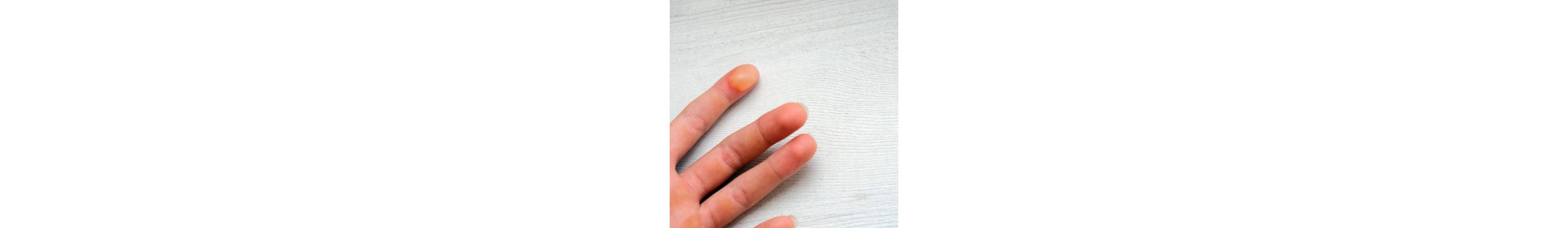 Soins Apres Brulures et Engelures