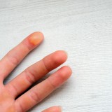 Soins Apres Brulures et Engelures